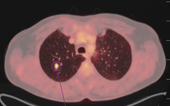 Řez plicemi z CT screeningu: Stagingové PET/CT v 2/2021 potvrzuje plicní diseminaci.