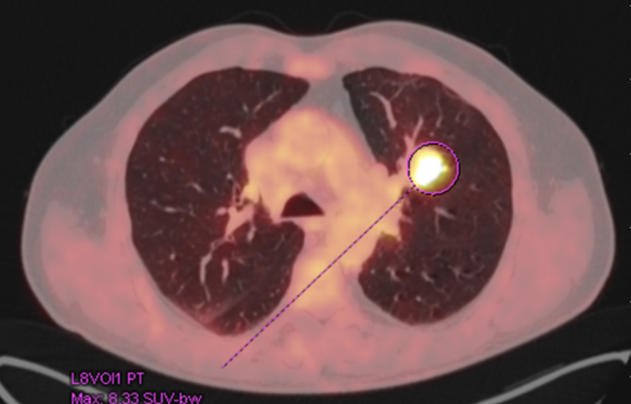 Řez plicemi z CT screeningu: Stagingové PET/CT v 2/2021 potvrzuje plicní diseminaci.