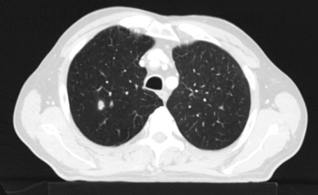 Řez plicemi z CT screeningu: Kontrolní  CT plic před zahájením léčby pembrolizumabem v 10/2021