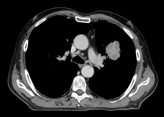 Řez plicemi z CT screeningu: Kontrolní  CT plic před zahájením léčby pembrolizumabem v 10/2021