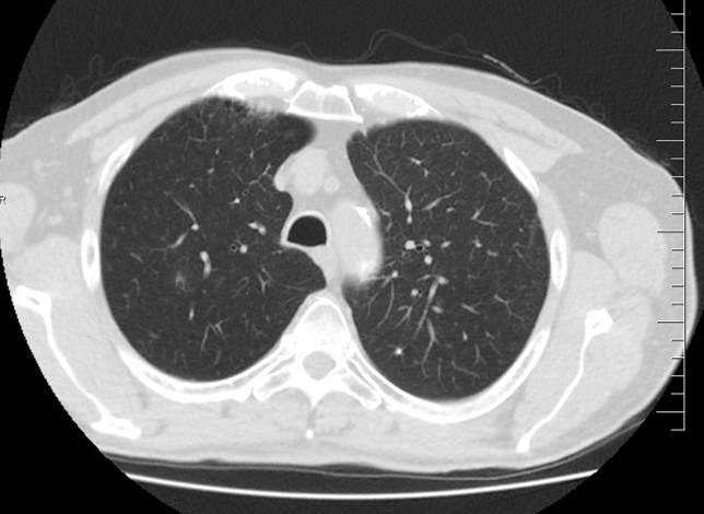 Řez plicemi z CT screeningu: Kontrolní CT plic po 2 sériích léčby pembrolizumabem v 1/2022.