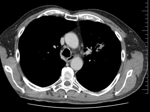 Řez plicemi z CT screeningu: Kontrolní  CT plic po 2 sériích léčby pembrolizumabem v 1/2022.