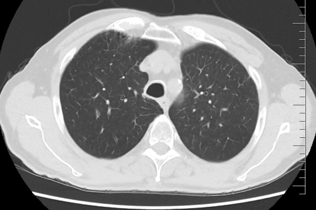 Řez plicemi z CT screeningu: CT plic z 11/2023 s nálezem trvající téměř kompletní remise (stacionární atelektáza plicního pole vlevo)