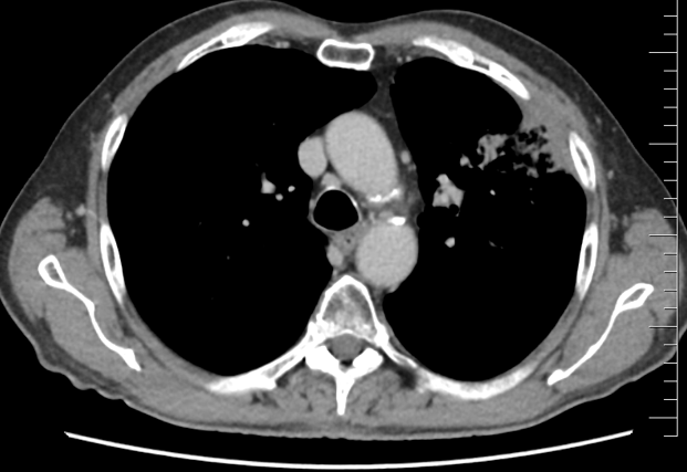 Řez plicemi z CT screeningu: CT plic z 11/2023 s nálezem trvající téměř kompletní remise (stacionární atelektáza plicního pole vlevo)