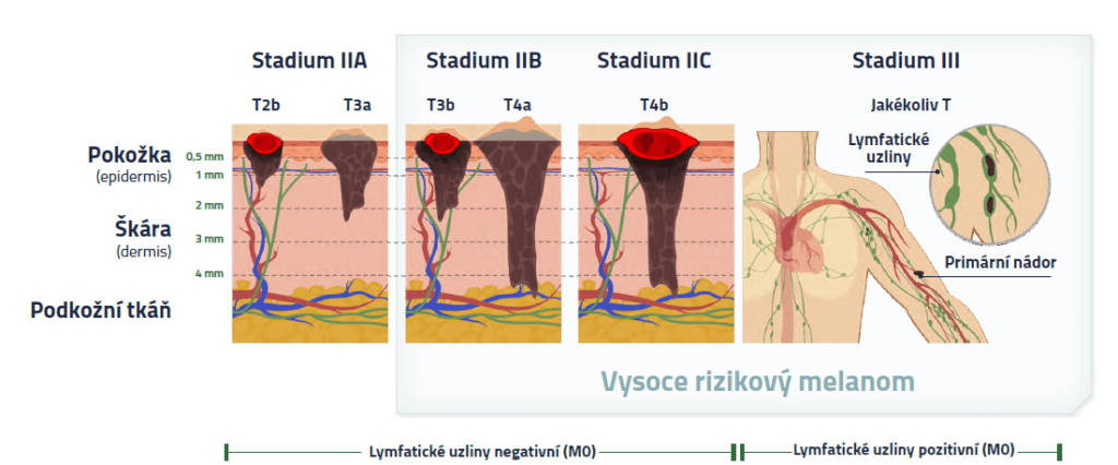 Grafika: Stadia melanomu IIA, IIB, IIC a III