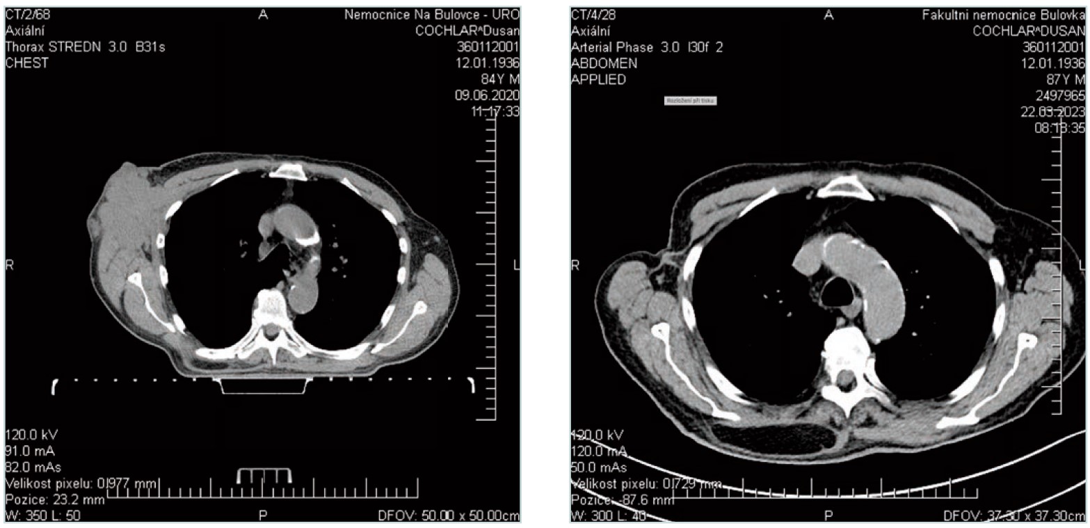 Snímek axilly před zahájením léčby a po jejím ukončení. Dokládající dosažení kompletní regrese.
