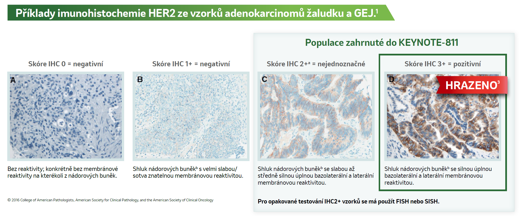 Obrázek: Příklady imunohistochemie HER2 ze vzorků adenokarcinomů žaludku a GEJ.